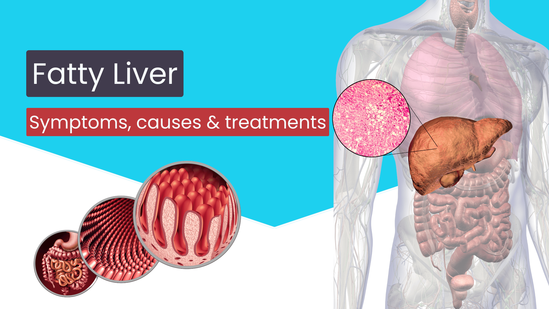 Fatty Liver Symptoms, causes & treatments